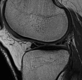 Anterior Horn Meniscal Tear Stoller Grade 3